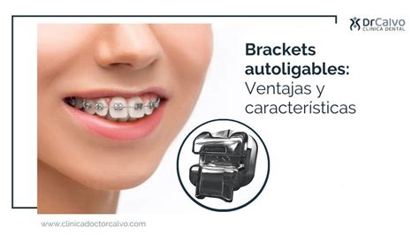 brackets metalicos y autoligables|brackets autoligables beneficios.